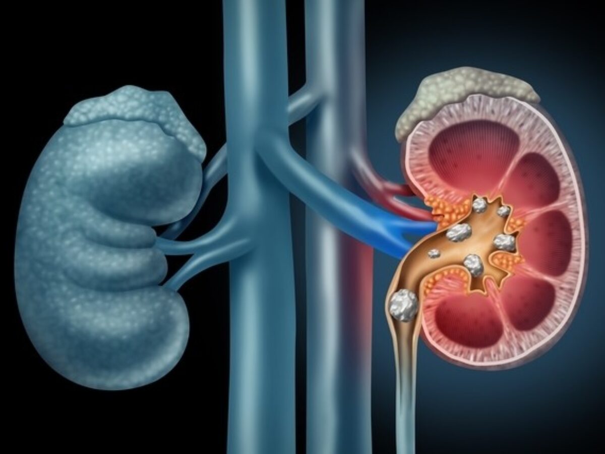 Qual o tamanho da pedra no rim para fazer cirurgia? - Clínica SepamClínica  Sepam